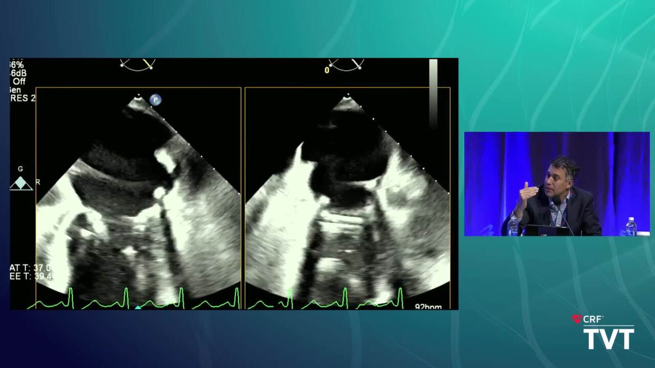 Live Case 26: M3 TMVR (ENCIRCLE) - Mayo Clinic, Rochester, MN