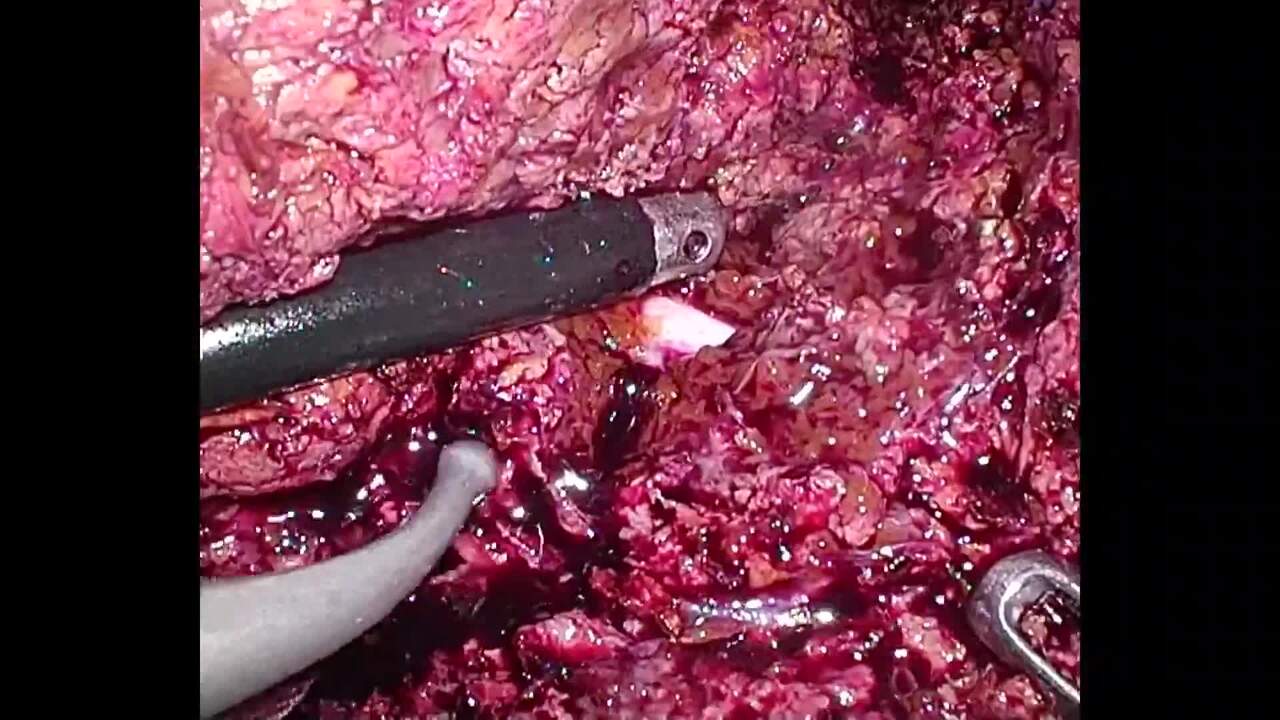 Clamp–Crushing Technique</br>for Laparoscopic Liver