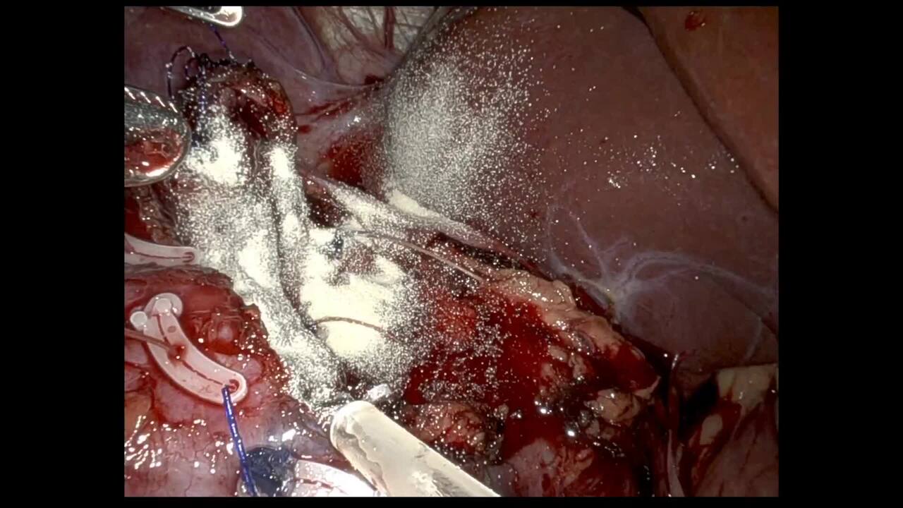 Robotic Prostatectomy & Partial Nephrectomy