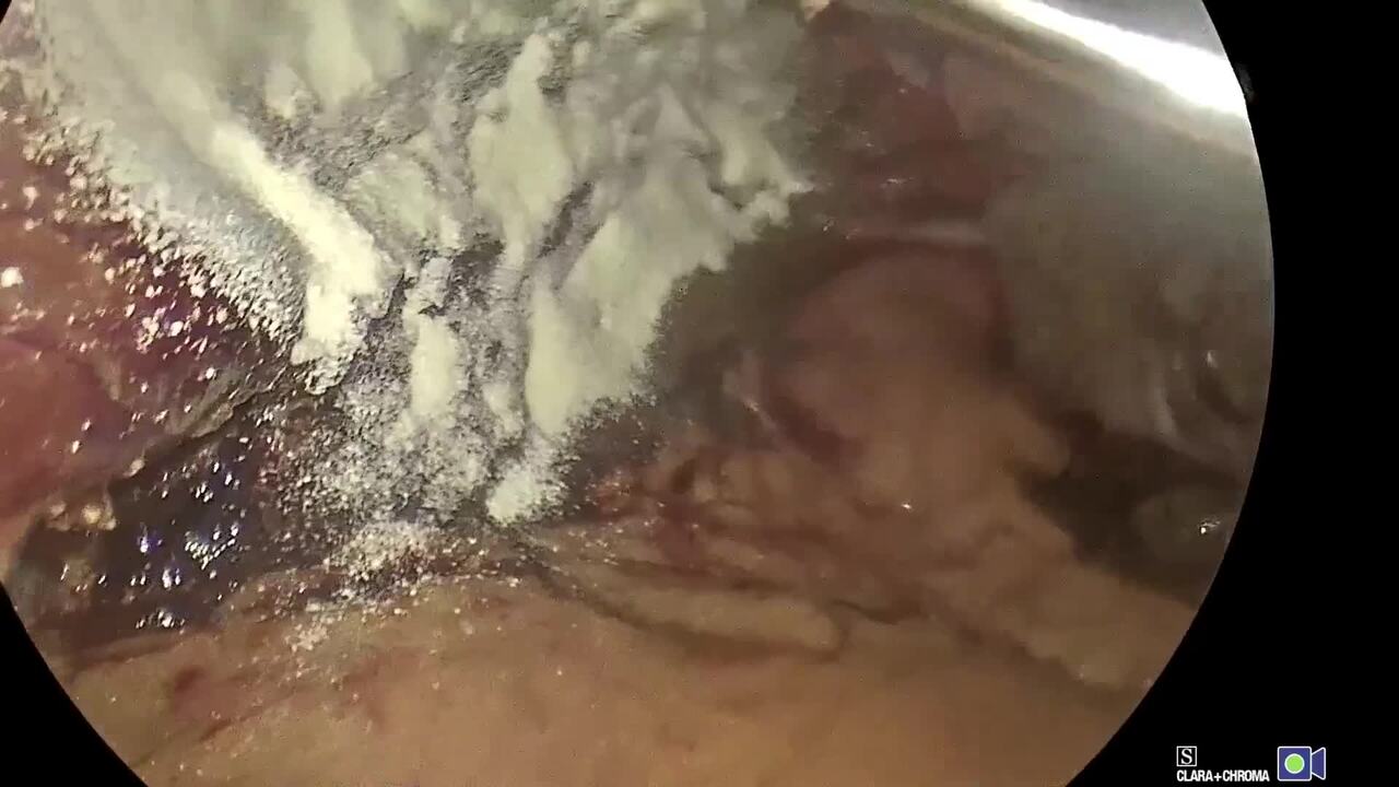 SURGICEL Powder Multi-Specialty Videos_HPB