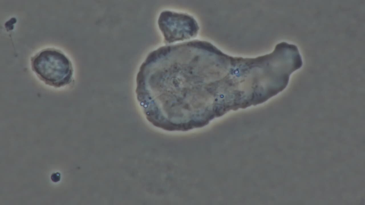 In vitro visualization of natural killer cells attacking cancer