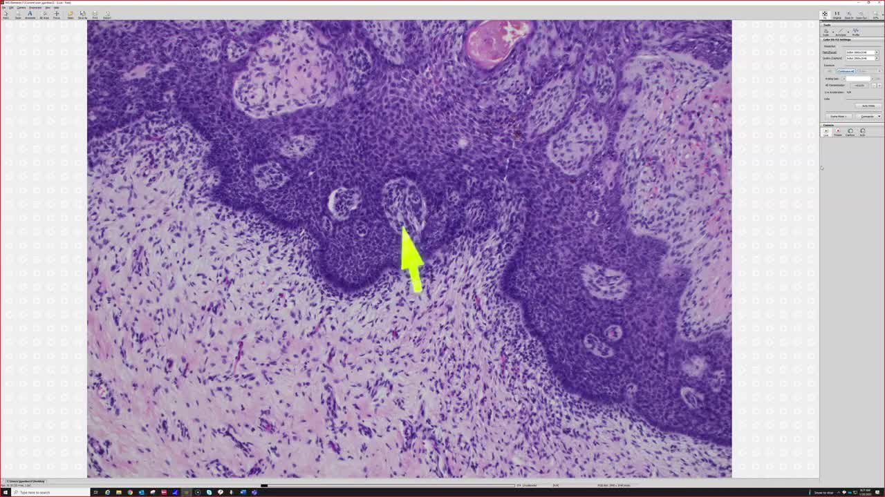 Fep Derm Fibroepithelioma Of Pinkus Treatment