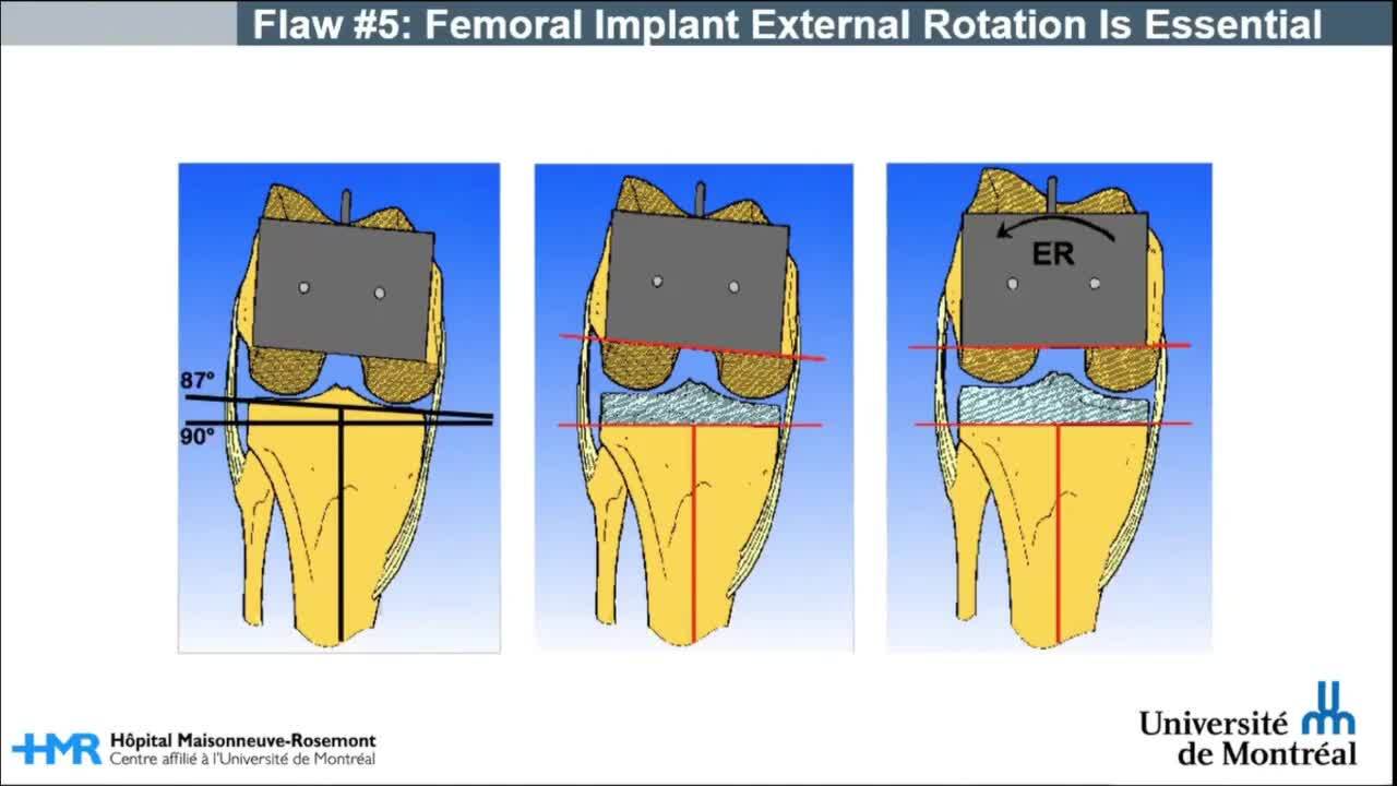 Manipulation of Extremity 中川貴雄著 9 Flaws of Mechanical Alignment Total Knee Arthroplasty | VuMedi