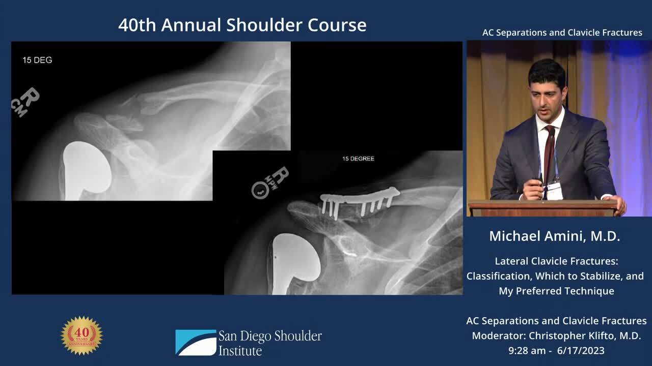 clavicle fracture classification