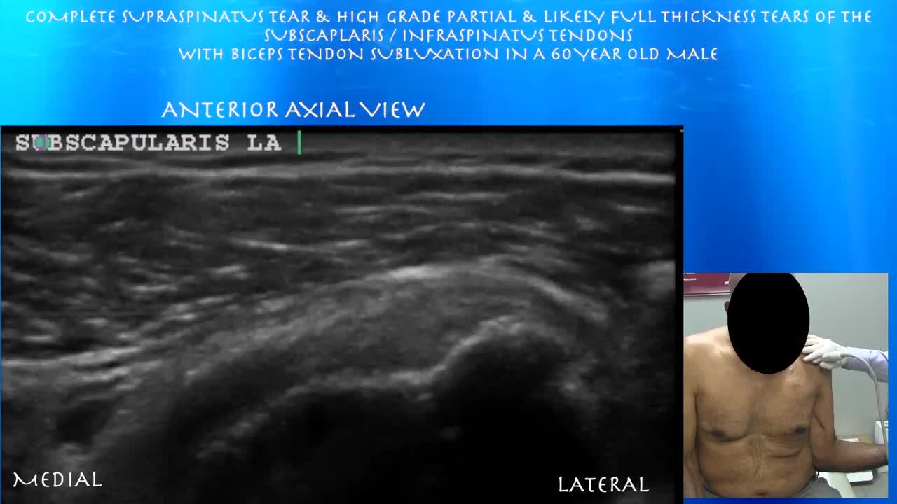 Complete Supraspinatus and a High-Grade Partial Tear of the Subscapularis /  Infraspinatus Tendons with Biceps Tendon Subluxation: Ultrasound