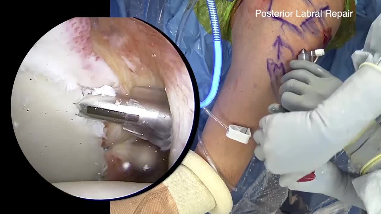 Posterior Labral Repair and Reverse Remplissage, image size:1280x720