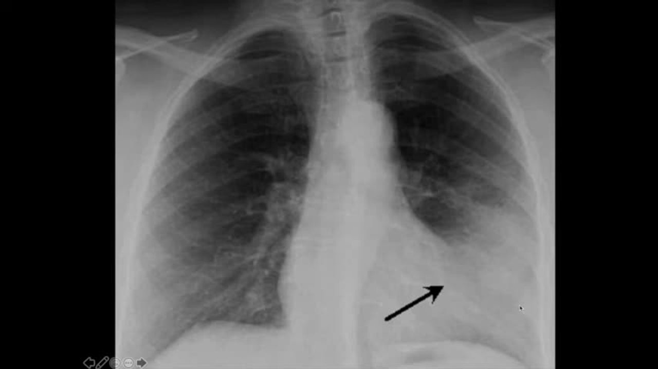 How To Identify Pneumothorax On Chest X Ray
