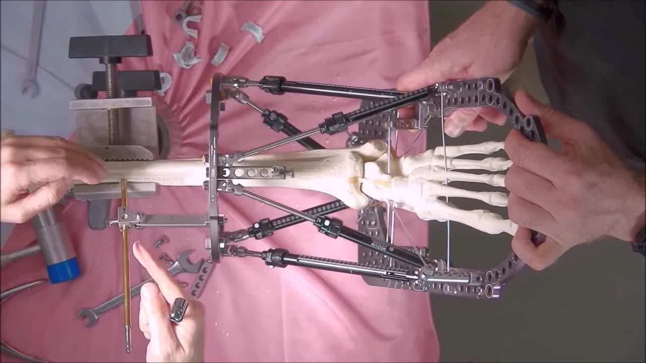 How to Manage an Equinus Correction with SMART TSF Circular