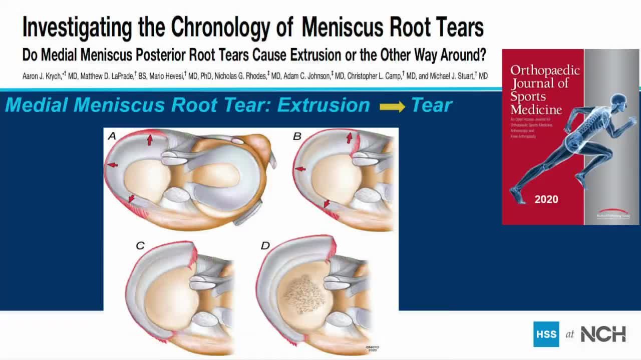 Medial Meniscus Posterior Root Anatomy