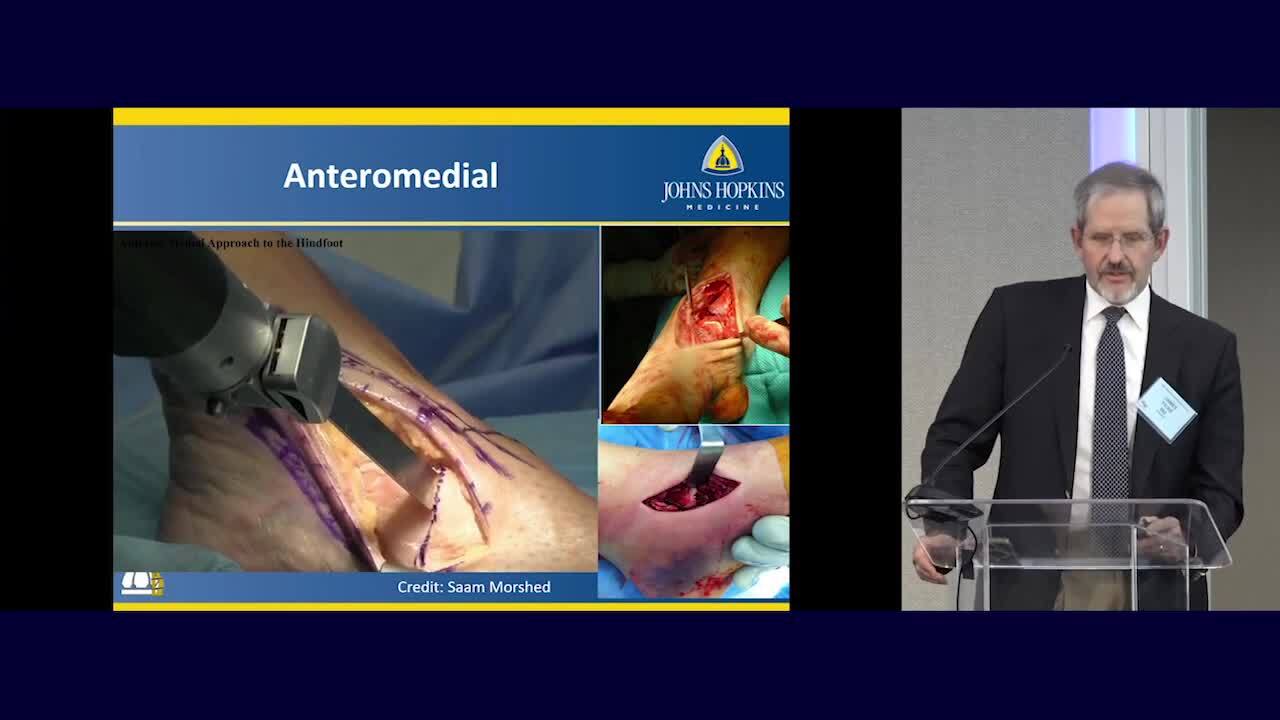 Talus Neck/Body Fractures: Approach and Fixation 2024