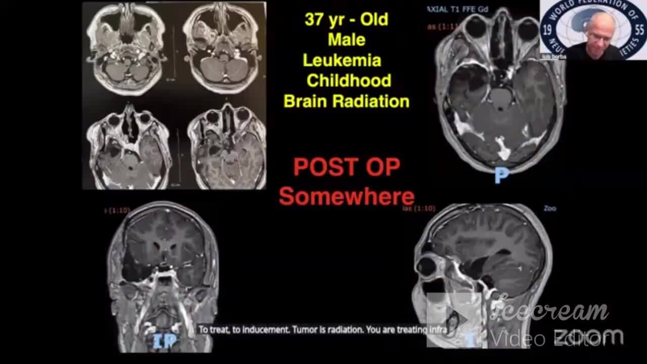 Skull Base Meningiomas: Surgery vs Gamma Knife | Vumedi