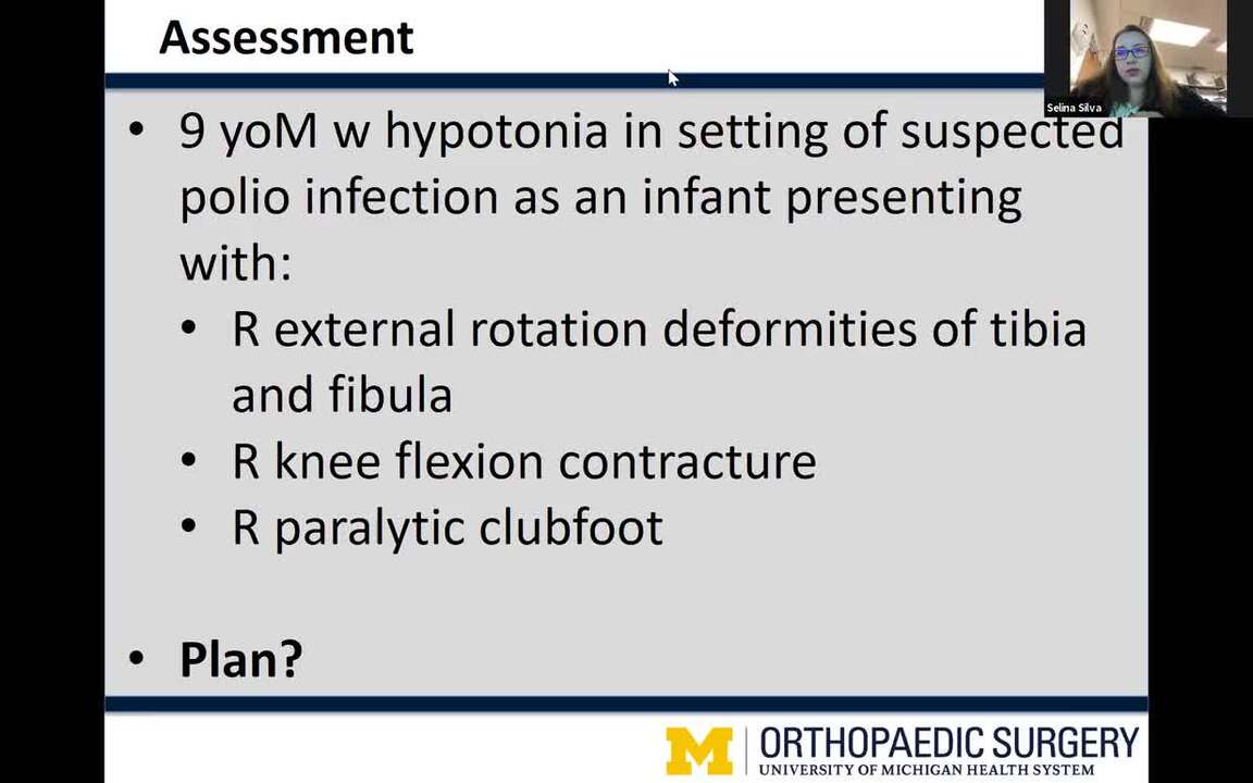 Clubfoot  Johns Hopkins Medicine