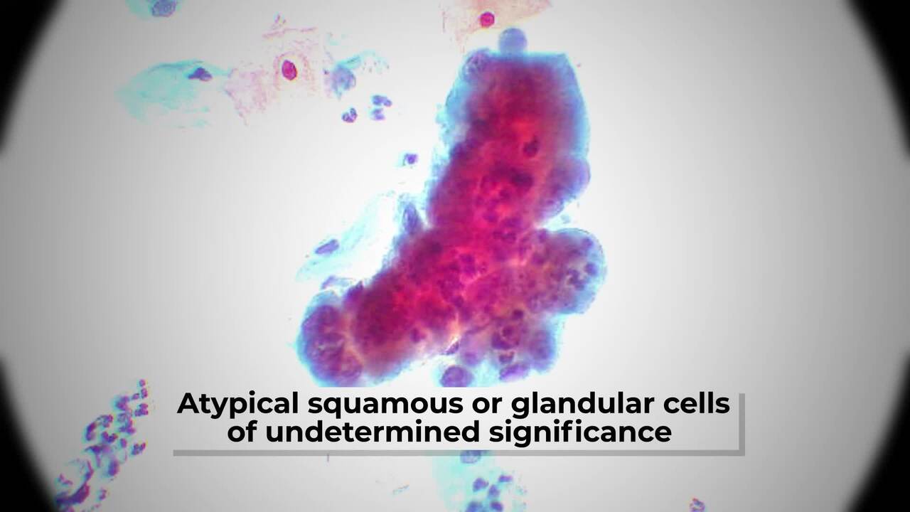 Cervical Cancer - Your Pathologist