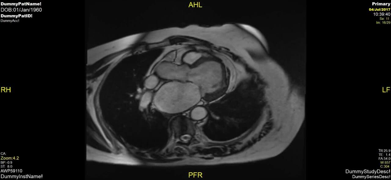 Isolated Left Ventricular Apical Hypoplasia