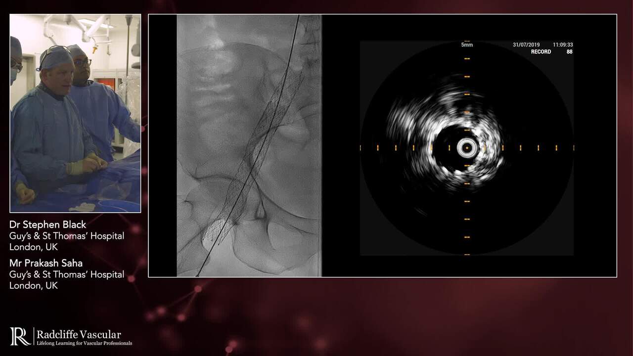 Stenting Unilateral Chronic Disease on Right-hand Side | Radcliffe Vascular