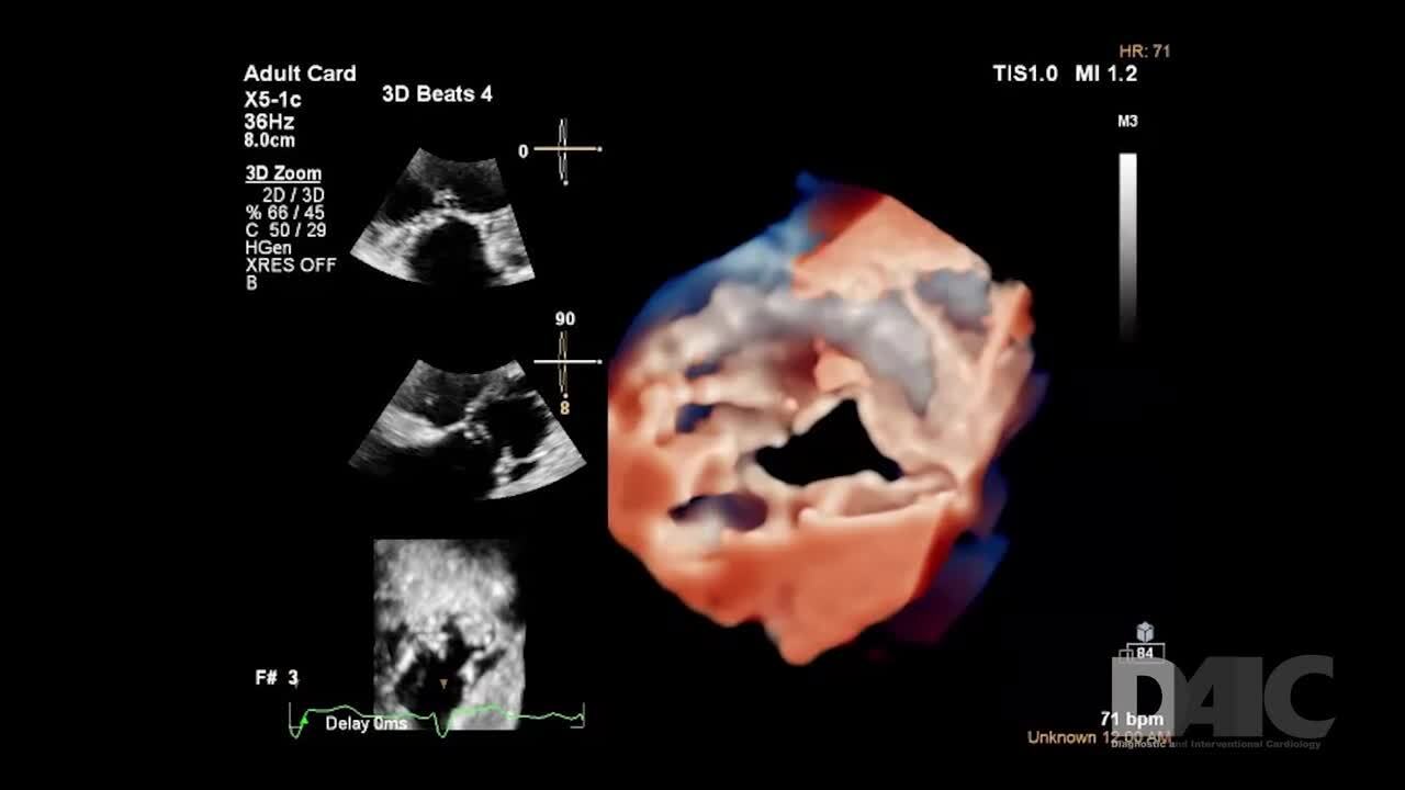 VIDEO: Philips EPIQ CVx with Cardiac TrueVue for next level photorealistic  3D rendering