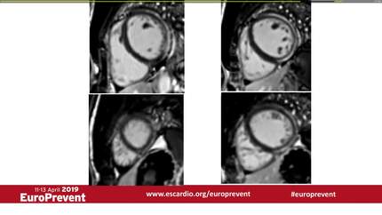 Syncope in an athlete; Listen to the story!