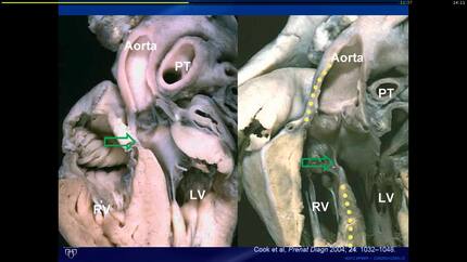 Post-surgical anatomy.