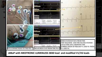 A mcgyvering way to left bundle branch area pacing : using the treadmill test machine ECG system and modified V1 / V6 leads  connected to the pacing system analyser for left bundle branch area pacing