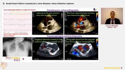 Acute heart failure causing by a rare disease: sinus Valsalva rupture.