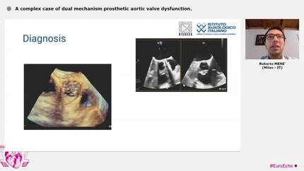 A complex case of dual mechanism prosthetic aortic valve dysfunction.