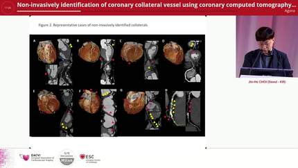Non-invasively identification of coronary collateral vessel using coronary computed tomography angiography