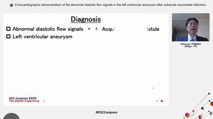 Echocardiographic demonstration of the abnormal diastolic flow signals in the left ventricular aneurysm after subacute myocardial infarction.