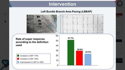 Predictors of super response to left bundle branch area pacing for cardiac resynchronization therapy