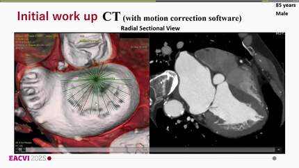 CT-guided transcatheter mitral edge-to-edge repair -A new standard for structural heart disease imaging-