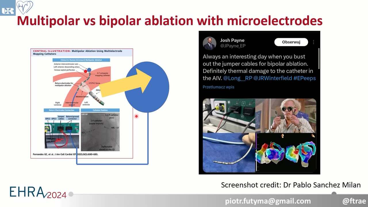 Tripolar catheter ablation of a refractory left ventricular summit arrythmia