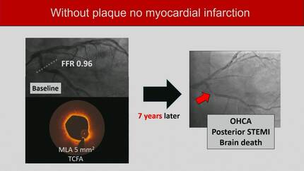 Transforming clinical practice: evaluating and managing LDL-C exposure for atherosclerotic cardiovascular disease (ASCVD) prevention