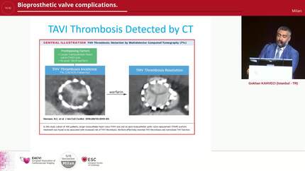 Bioprosthetic valve complications.