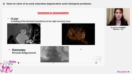 Valve-in-valve of an early sutureless degenerative aortic biological prosthesis.