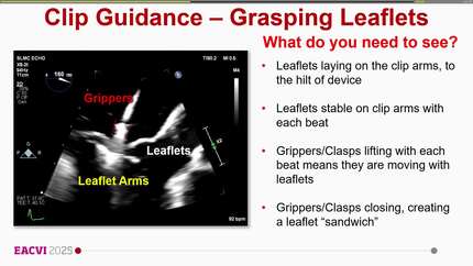 Tea-for-two in the cath lab: image guidance MV-TEER