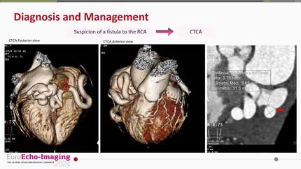 Unveiling a giant coronary artery fistula in an asymptomatic woman: a multimodal imaging case study