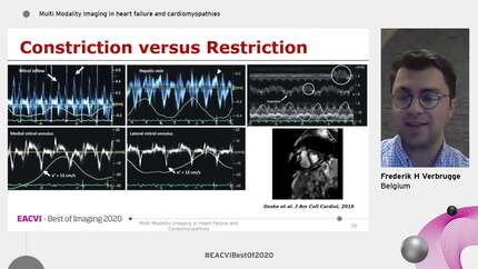 Multi Modality Imaging in heart failure and cardiomyopathies