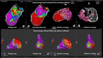 Preliminary experience on dual-energy ablation for ventricular tachycardia