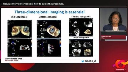 Imaging to guide transcatheter intervention in tricuspid regurgitation
