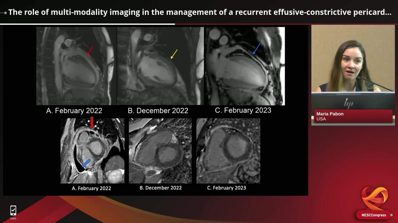 The role of multi-modality imaging in the management of a recurrent effusive-constrictive pericarditis in patient with T-cell acute lymphoblastic leukemia (T-ALL)
