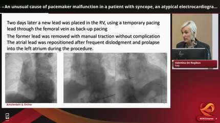 Syncope 