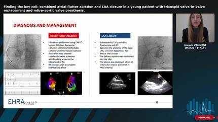 Finding the key coil: combined atrial flutter ablation and LAA closure in a young patient with tricuspid valve-in-valve replacement and mitro-aortic valve prosthesis.