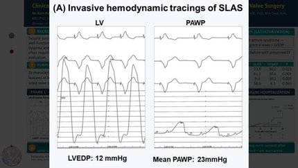 Clinical features of late-onset pulmonary hypertension  after successful left-sided valve surgery