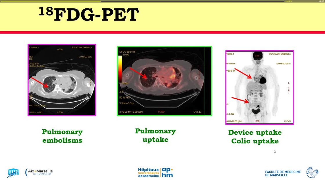 ESC 365 - Endocarditis in a patient with a cardiac implanted electronic ...