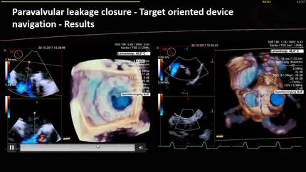 Making interventional procedures with fusion technology