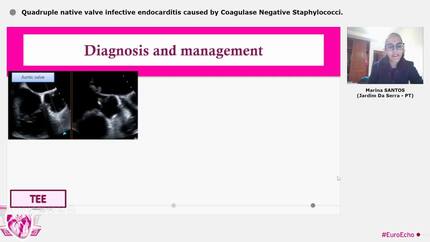Quadruple native valve infective endocarditis caused by Coagulase Negative Staphylococci.