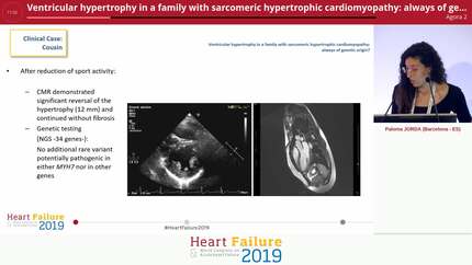 Ventricular hypertrophy in a family with sarcomeric hypertrophic cardiomyopathy: always of genetic origin?