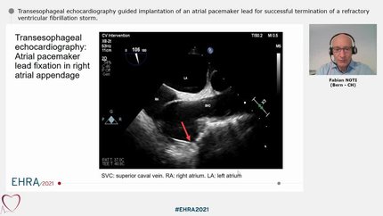Transesophageal echocardiography guided implantation of an atrial pacemaker lead for successful termination of a refractory ventricular fibrillation storm.