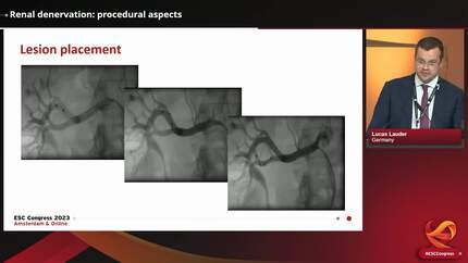 Renal denervation in hypertension management: back in prime position?