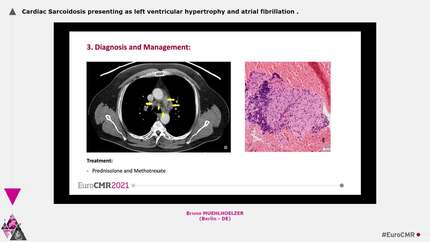 Cardiac Sarcoidosis presenting as left ventricular hypertrophy and atrial fibrillation
.