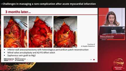 Challenges in managing a rare complication after acute myocardial infarction